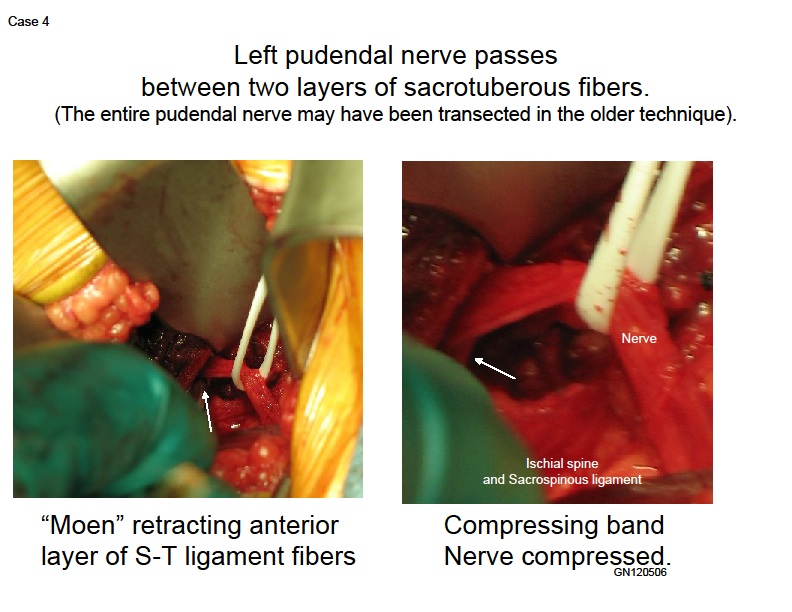 Falciform process of the Sacrotuberous ligament.jpg